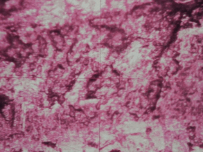 laserablation